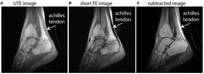 Achilles Subtendon Structure and Behavior as Evidenced From Tendon Imaging and Computational Modeling